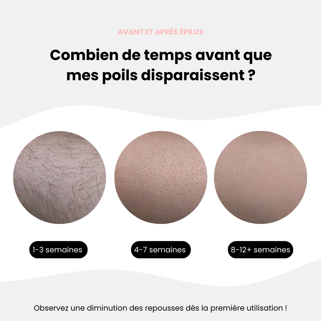 Épilux® I Épilation Semi-Définitive à la Lumière Pulsée